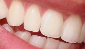 Gast breekt tand restauranteigenaar